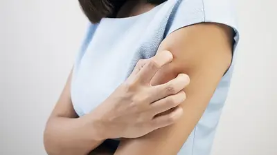 Culebrilla Culebrilla
