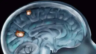 Se confirmó la primera muerte en Corea del Sur por la ameba "comecerebros". Se confirmó la primera muerte en Corea del Sur por la ameba "comecerebros".