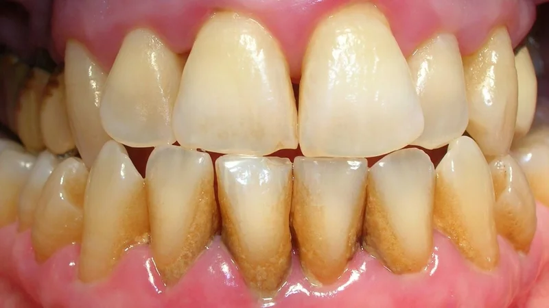 Dientes con sarro