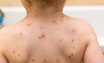 Alerta por sarampión: la familia que cruzó medio país tuvo al menos 98 contactos estrechos | Contagios